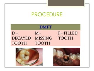 DMFT INDEX.pptx