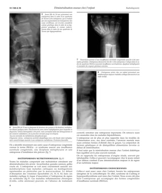 31-150-A-10 Déminéralisation osseuse chez l’enfant Radiodiagnostic 
On a identifié récemment une autre cause d’ostéoporose congénitale 
connue le terme IMAGe : ce syndrome associe une insuffisance 
surrénale congénitale, une dysplasie métaphysaire et une 
ostéoporose d’installation très précoce (fig 7). 
OSTÉOPOROSES NUTRITIONNELLES (fig 8) 
Toutes les maladies comportant une malnutrition entraînent une 
déminéralisation très sévère : kwarchiorkor, grandes carences, grêles 
courts etc. L’ostéoporose se voit aussi couramment associée aux 
malabsorptions type maladies coeliaques ou maldigestions 
représentées en particulier par la mucoviscidose. Le défaut 
d’absorption des vitamines liposolubles (A, D, E, K) dans ces 
maladies explique le risque d’association à l’ostéoporose de signes 
de rachitisme (fig 9). Les maladies inflammatoires chroniques 
(Crohn, colite ulcéreuse) peuvent, en l’absence de traitement 
correctif, entraîner une ostéoporose importante. On retrouve aussi 
ces anomalies dans les maladies hépatobiliaires. 
L’ostéoporose est de plus en plus rapportée dans les troubles de 
l’alimentation avec, aux deux extrêmes, l’anorexie mentale mais 
aussi certaines formes d’obésité chez le garçon. La conjonction de 
facteurs génétiques et de déséquilibres alimentaires favorise ce 
défaut de minéralisation. 
Il faut noter que la minéralisation osseuse chez l’enfant diabétique 
bien équilibré est le plus souvent normale. 
On en rapproche les ostéoporoses d’origine rénale, souvent par 
tubulopathie. Celles-ci peuvent s’accompagner chez le jeune enfant 
d’un tableau combiné d’une déminéralisation majeure et de signes 
d’un rachitisme majeur. 
OSTÉOPOROSES ENDOCRIENNES 
Celles-ci sont assez rares chez l’enfant, hormis les ostéoporoses 
iatrogènes de la corticothérapie. En effet, syndrome de Cushing et 
hyperparathyroïdisme sont rares chez l’enfant. Nous avons cité plus 
haut l’ostéoporose qui accompagne des formes congénitales 
d’insuffisance surrénale (IMAGe). 
5 Jeune fille de 14 ans présentant une 
ostéoporose dans le cadre d’un syndrome 
de Turner.Cette ostéoporose, qui se traduit 
par une augmentation de transparence des 
corps vertébraux, est à la fois considérée 
comme génétique dans le cadre de sa dys-génésie 
gonadique et comme endocri-nienne 
dans le cadre de son syndrome de 
Turner par hypogonadisme. 
6 Jeune fille de 15 ans se plaignant de douleurs des genoux et de douleurs rachidien-nes 
depuis quelques mois. Découverte de zones claires métaphysaires pour lesquelles le 
diagnostic initial d’hémopathie a été porté, mais normalité totale des hémogrammes et 
des examens médullaires, de la ponction sternale jusqu’à la biopsie. 
Aucune anomalie du métabolisme phosphocalcique. 
Diagnostic retenu : ostéoporose juvénile idiopathique avec cette bande claire métaphy-saire 
caractéristique associée à une ostéoporose rachidienne. Évolution favorable. 
7 Nourrisson porteur d’une insuffisance surrénale congénitale associée à des ano-malies 
génitales. Ostéoporose découverte très tôt. Cette ostéoporose s’intègre dans le ca-dre 
du syndrome IMAGe associant insuffisance surrénalienne, dysplasie métaphysaire 
et anomalie des organes génitaux externes. 
8 Ostéoporose sévère chez un enfant présentant une 
malabsorption majeure (maladie coeliaque découverte à un 
stade tardif). 
4 
 