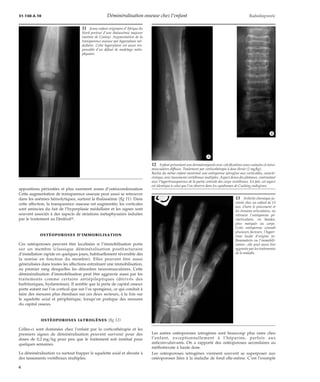 31-150-A-10 Déminéralisation osseuse chez l’enfant Radiodiagnostic 
appositions périostées et plus rarement zones d’ostéocondensation 
Cette augmentation de transparence osseuse peut aussi se retrouver 
dans les anémies hémolytiques, surtout la thalassémie (fig 11). Dans 
cette affection, la transparence osseuse est augmentée, les corticales 
sont amincies du fait de l’hyperplasie médullaire et les signes sont 
souvent associés à des aspects de striations métaphysaires induites 
par le traitement au Desféralt. 
OSTÉOPOROSES D’IMMOBILISATION 
Ces ostéoporoses peuvent être localisées si l’immobilisation porte 
sur un membre (classique déminéralisation postfracturaire 
d’installation rapide en quelques jours, habituellement réversible dès 
la remise en fonction du membre). Elles peuvent être aussi 
généralisées dans toutes les affections entraînant une immobilisation, 
au premier rang desquelles les désordres neuromusculaires. Cette 
déminéralisation d’immobilisation peut être aggravée aussi par les 
traitements comme certains antiépileptiques (dérivés des 
barbituriques, hydantoïnes). Il semble que la perte de capital osseux 
porte autant sur l’os cortical que sur l’os spongieux, ce qui conduit à 
faire des mesures plus étendues sur ces deux secteurs, à la fois sur 
le squelette axial et périphérique, lorsqu’on pratique des mesures 
du capital osseux. 
OSTÉOPOROSES IATROGÈNES (fig 12) 
Celles-ci sont dominées chez l’enfant par la corticothérapie et les 
premiers signes de déminéralisation peuvent survenir pour des 
doses de 0,2 mg/kg pour peu que le traitement soit institué pour 
quelques semaines. 
La déminéralisation va surtout frapper le squelette axial et aboutir à 
des tassements vertébraux multiples. 
*A 
*B 
Les autres ostéoporoses iatrogènes sont beaucoup plus rares chez 
l’enfant, exceptionnellement à l’héparine, parfois aux 
anticonvulsivants. On a rapporté des ostéoporoses secondaires au 
méthotrexate à haute dose. 
Les ostéoporoses iatrogènes viennent souvent se superposer aux 
ostéoporoses liées à la maladie de fond elle-même. C’est l’exemple 
11 Jeune enfant originaire d’Afrique du 
Nord porteur d’une thalassémie majeure 
(anémie de Cooley). Augmentation de la 
transparence osseuse par hyperplasie mé-dullaire. 
Cette hyperplasie est aussi res-ponsable 
d’un défaut de modelage méta-physaire. 
12 Enfant présentant une dermatomyosite avec calcifications sous-cutanées et intra-musculaires 
diffuses. Traitement par corticothérapie à dose élevée (2 mg/kg). 
Rachis du même enfant montrant une ostéoporose iatrogène aux corticoïdes, caracté-ristique, 
avec tassements vertébraux multiples. Aspect dense des plateaux, contrastant 
avec l’hypertransparence de la partie centrale des corps vertébraux. En fait, cet aspect 
est identique à celui que l’on observe dans les syndromes de Cushing endogènes. 
13 Arthrite chronique ju-vénile 
chez un enfant de 13 
ans. Outre le pincement et 
les érosions articulaires, on 
retrouve l’ostéoporose pé-riarticulaire, 
en bandes, 
plus marquée au carpe. 
Cette ostéoporose connaît 
plusieurs facteurs, l’hyper-émie 
locale d’origine in-flammatoire 
ou l’immobili-sation 
; elle peut aussi être 
aggravée par les traitements 
de la maladie. 
6 
 