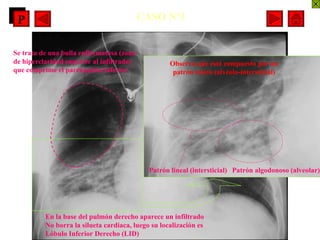 CASO Nº1 En la base del pulmón derecho aparece un infiltrado  No borra la silueta cardiaca, luego su localización es Lóbulo Inferior Derecho (LID) Observa que está compuesto por un patrón mixto (alvéolo-intersticial) Patrón algodonoso (alveolar) Patrón lineal (intersticial) Se trata de una bulla enfisematosa (zona de hiperclaridad superior al infiltrado) que comprime el parénquima inferior P P 