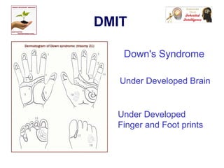 DMIT
Down's Syndrome
Under Developed
Finger and Foot prints
Under Developed Brain
 