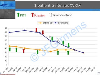 1 patient traité aux XV-XX © JFGirmens Krypton PDT Triamcinolone 