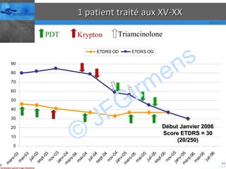 1 patient traité aux XV-XX Krypton PDT Triamcinolone Début Janvier 2006 Score ETDRS = 30 (20/250) © JFGirmens 