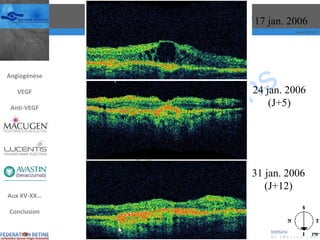 17 jan. 2006 24 jan. 2006 (J+5) 31 jan. 2006 (J+12) Angiogénèse VEGF Anti-VEGF Aux XV-XX… Conclusion 