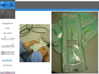 Angiogénèse VEGF Anti-VEGF Aux XV-XX… Conclusion 