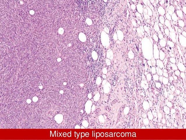 Update On Soft Tissue Tumors
