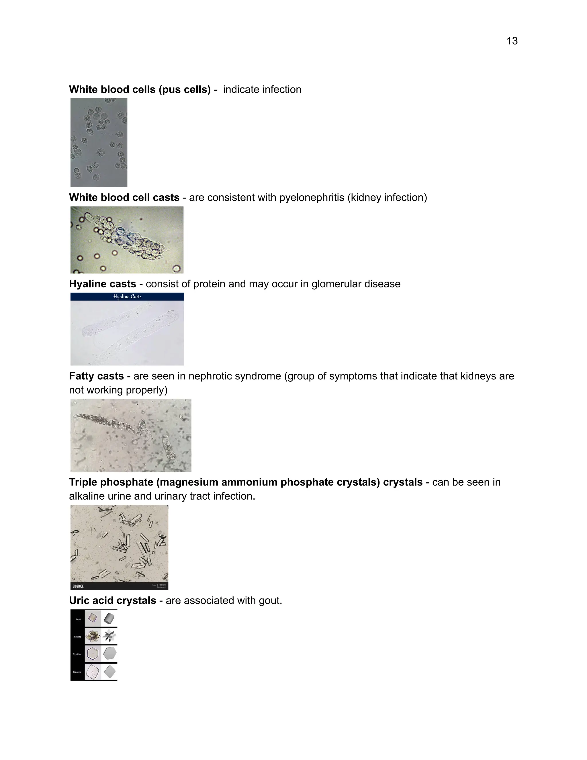 13
White blood cells (pus cells) - indicate infection
White blood cell casts - are consistent with pyelonephritis (kidney infection)
Hyaline casts - consist of protein and may occur in glomerular disease
Fatty casts - are seen in nephrotic syndrome (group of symptoms that indicate that kidneys are
not working properly)
Triple phosphate (magnesium ammonium phosphate crystals) crystals - can be seen in
alkaline urine and urinary tract infection.
Uric acid crystals - are associated with gout.
 