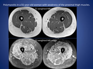 Polymyositis in a 55-year-old woman with weakness of the proximal thigh muscles.
T1-weighted MR image
T2-weighted MR image
 