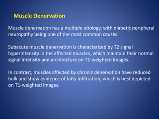 Muscle Denervation
Muscle denervation has a multiple etiology, with diabetic peripheral
neuropathy being one of the most common causes.
Subacute muscle denervation is characterized by T2 signal
hyperintensity in the affected muscles, which maintain their normal
signal intensity and architecture on T1-weighted images.
In contrast, muscles affected by chronic denervation have reduced
bulk and show evidence of fatty infiltration, which is best depicted
on T1-weighted images.
 