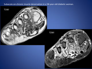 Subacute-on-chronic muscle denervation in a 58-year-old diabetic woman.
T1WI
T2WI
 
