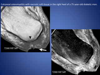 Calcaneal osteomyelitis with necrotic soft tissue in the right heel of a 75-year-old diabetic man.
T1WI FAT SAT
T2WI FAT SAT
 