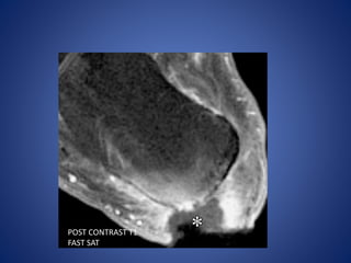 POST CONTRAST T1
FAST SAT
 