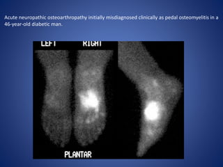 Acute neuropathic osteoarthropathy initially misdiagnosed clinically as pedal osteomyelitis in a
46-year-old diabetic man.
 