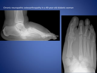 Chronic neuropathic osteoarthropathy in a 49-year-old diabetic woman
 