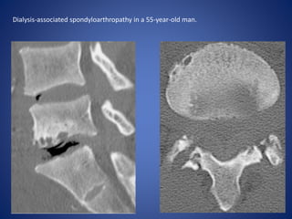 Dialysis-associated spondyloarthropathy in a 55-year-old man.
 