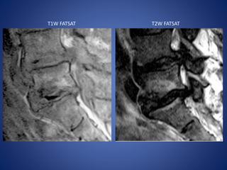 T1W FATSAT T2W FATSAT
 