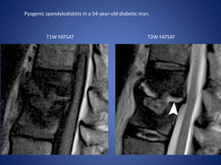 Pyogenic spondylodiskitis in a 54-year-old diabetic man.
T1W FATSAT T2W FATSAT
 