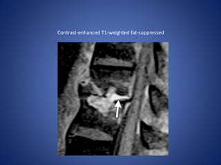 Contrast-enhanced T1-weighted fat-suppressed
 