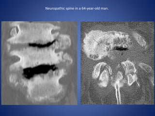 Neuropathic spine in a 64-year-old man.
 