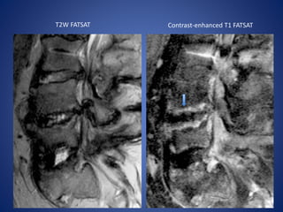 T2W FATSAT Contrast-enhanced T1 FATSAT
 