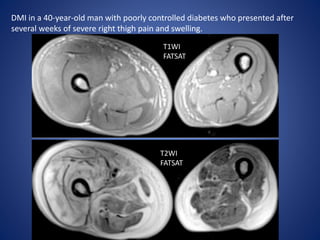 DMI in a 40-year-old man with poorly controlled diabetes who presented after
several weeks of severe right thigh pain and swelling.
T1WI
FATSAT
T2WI
FATSAT
 