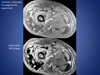 Contrast enhanced
T1-weighted fat-
suppressed
Subtraction
MR images
 