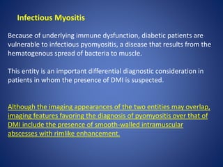 Infectious Pyomyositis Diabetes - Musculoskeletal Complication | PPTX