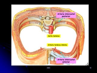 35
Arteria torácica interna
Aorta torácica
DMO
Arteria intercostal
posterior
Arteria intercostal
anterior
 