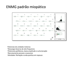 ENMG padrão miopático
Potenciais de unidades motoras:
•Descargas bizarras de alta frequencia
•Potenciais polifásicos, baixa amplitude e curta duração
•Recrutamento precoce e excessivo
•Atividade: fibrilação e onda positiva em repouso
 