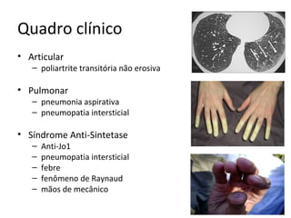 Quadro clínico
• Articular
– poliartrite transitória não erosiva
• Pulmonar
– pneumonia aspirativa
– pneumopatia intersticial
• Síndrome Anti-Sintetase
– Anti-Jo1
– pneumopatia intersticial
– febre
– fenômeno de Raynaud
– mãos de mecânico
 