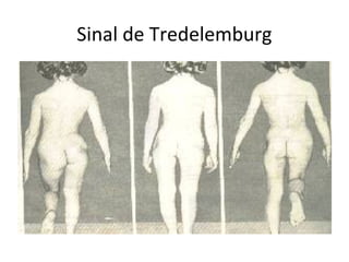 Sinal de Tredelemburg
 