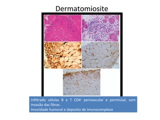 Dermatomiosite
Infiltrado células B e T CD4+
perivascular e perimisial, sem
invasão das fibras .
Imunidade humoral e deposito de imunocomplexo
 