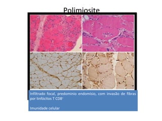 Polimiosite
Infiltrado focal, predominio endomísio, com invasão de fibras
por linfócitos T CD8+
Imunidade celular
 
