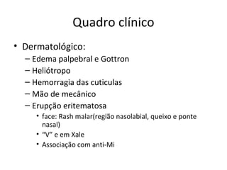 Quadro clínico
• Dermatológico:
– Edema palpebral e Gottron
– Heliótropo
– Hemorragia das cuticulas
– Mão de mecânico
– Erupção eritematosa
• face: Rash malar(região nasolabial, queixo e ponte
nasal)
• “V” e em Xale
• Associação com anti-Mi
 