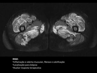 RNM:
•Inflamação e edema muscular, fibrose e calcificação
•Localização para biópsia
•Avaliar resposta terapeutica
 