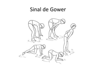 Sinal de Gower
 