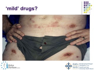 ‘mild’ drugs?
 