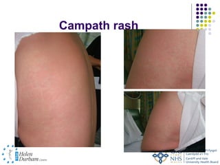 Campath rash
 
