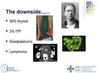 The downside......
   30% thyroid

   3% ITP

   Goodpasture’s

   Lymphoma
 