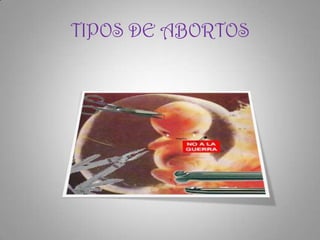 TIPOS DE ABORTOS
 