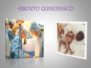 ABORTO QUIRURGICO
 