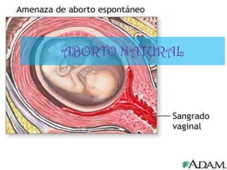 ABORTO NATURAL
 