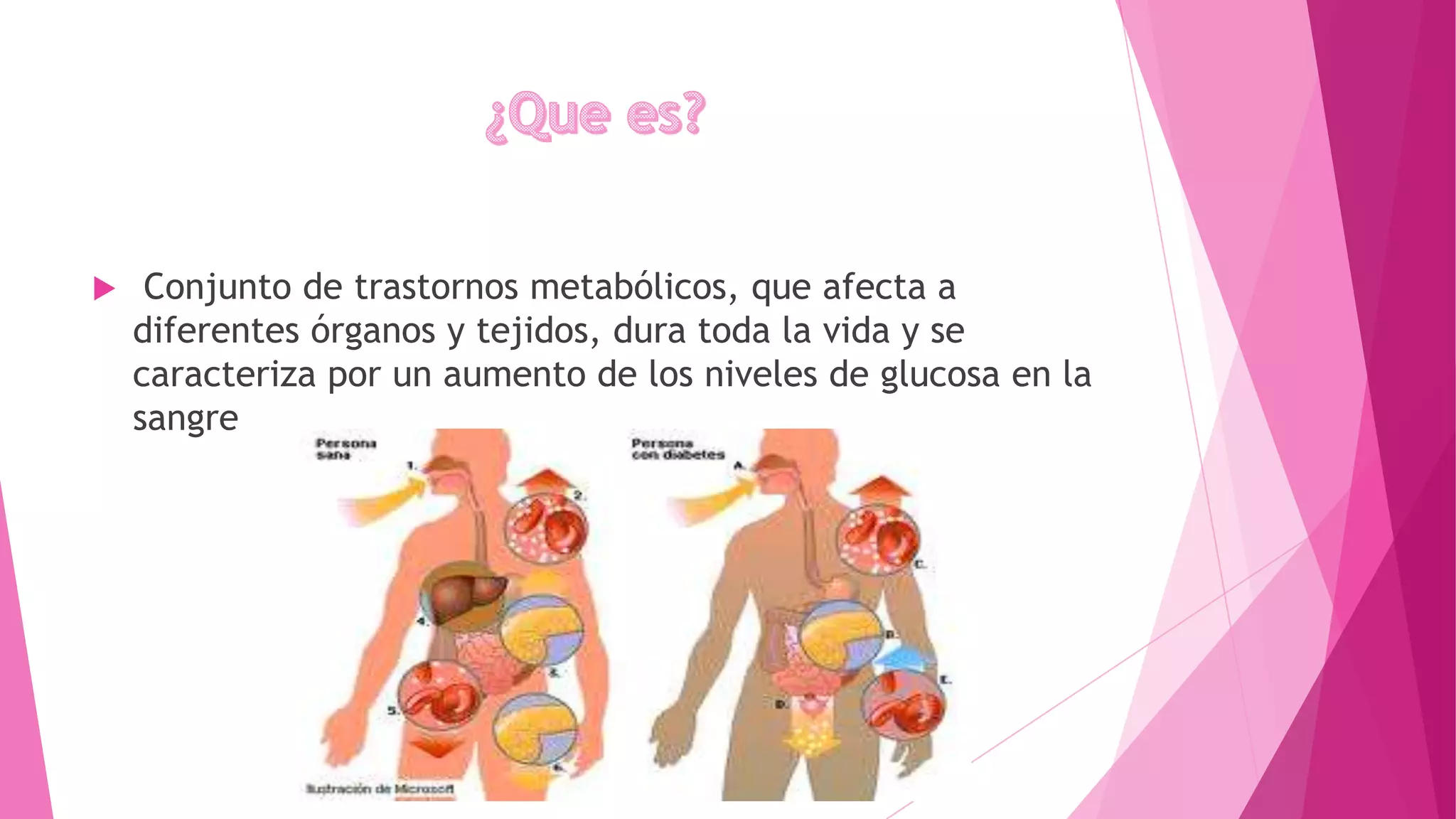  Conjunto de trastornos metabólicos, que afecta a
diferentes órganos y tejidos, dura toda la vida y se
caracteriza por un aumento de los niveles de glucosa en la
sangre