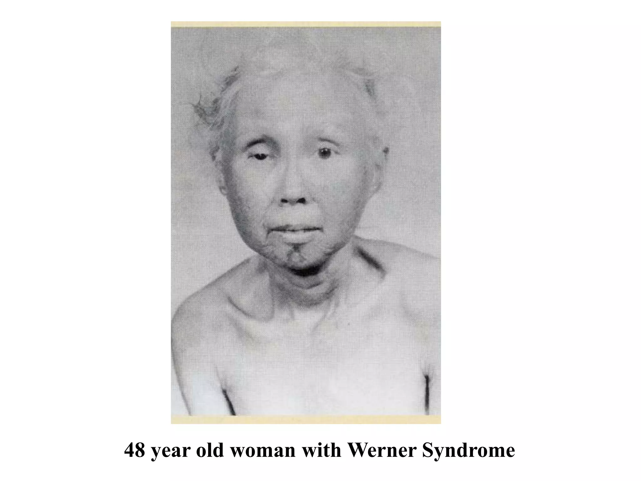 48 year old woman with Werner Syndrome
 