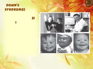 Down's
syndrome)

            21
    1
 