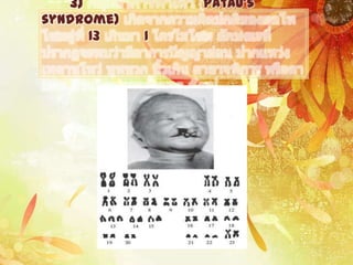3)           Patau's
syndrome)
      13    1
 