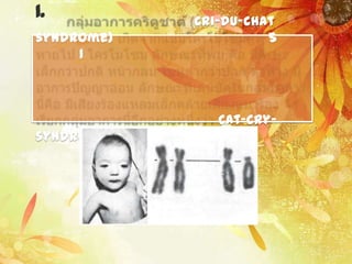 1.          Cri-du-chat
syndrome)             5
     1



               Cat-cry-
syndrome
 