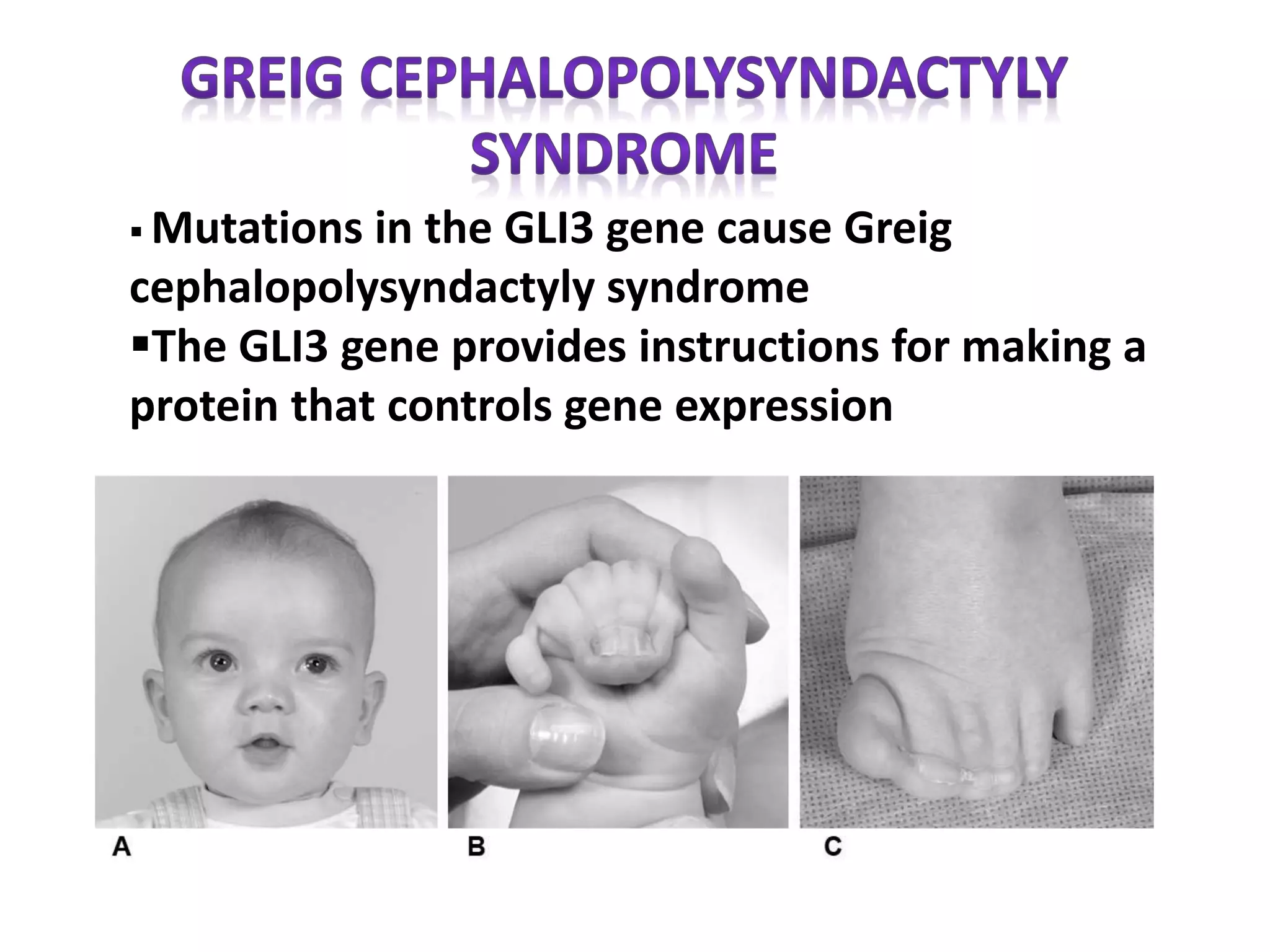  Mutations in the GLI3 gene cause Greig
cephalopolysyndactyly syndrome
The GLI3 gene provides instructions for making a
protein that controls gene expression
 