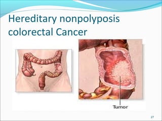 Hereditary nonpolyposis
colorectal Cancer
27
 