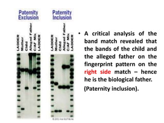 • A critical analysis of the
band match revealed that
the bands of the child and
the alleged father on the
fingerprint pattern on the
right side match – hence
he is the biological father.
(Paternity inclusion).
 